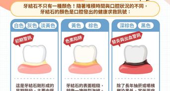 牙結石怎麼清？牙結石症狀、危害與預防全解析，刷牙刷得掉嗎？