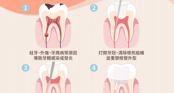 2026根管治療攻略》抽神經費用、健保給付與牙齒保養重點