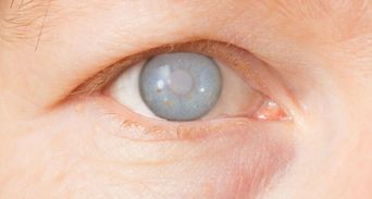 白內障位置決定失明風險！醫揭3大警訊，這混濁位置最危險