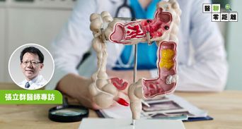 照大腸鏡別白忙！台大醫列3種人「追蹤時間表」這類息肉超快變癌