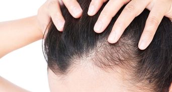 頭髮、髮線長回來了！35歲男實測「一治療」1個月告別掉髮