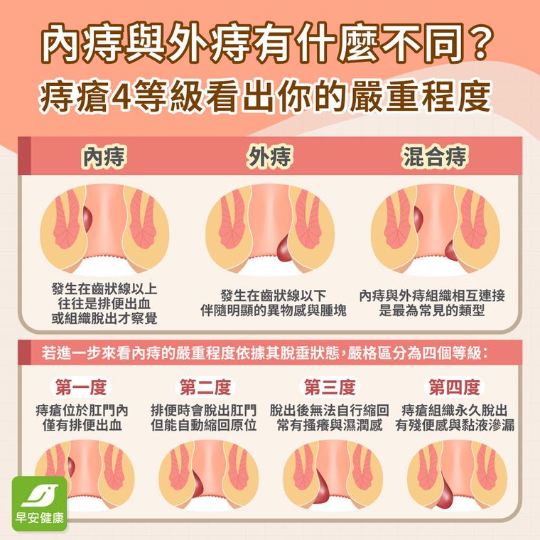 痔瘡會自己好嗎？痔瘡疼痛自救法、擦什麼藥膏與預防飲食