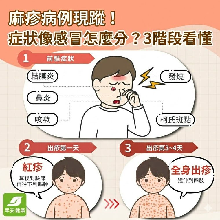 麻疹症狀像感冒？麻疹傳染途徑、潛伏期與疫苗接種懶人包