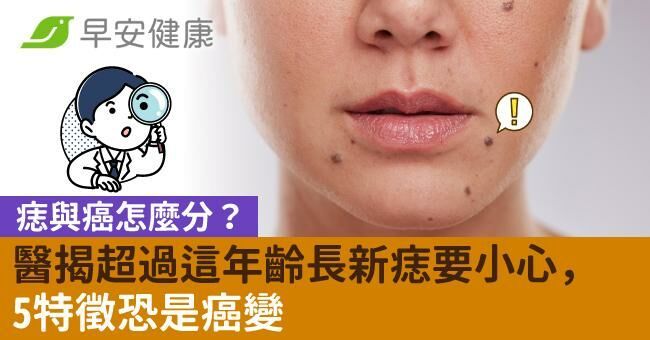 痣與癌怎麼分？醫揭超過這年齡長新痣要小心，5特徵恐是癌變