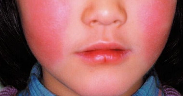 B19病毒蘋果病是什麼？傳染方式、潛伏期、病程症狀全解惑