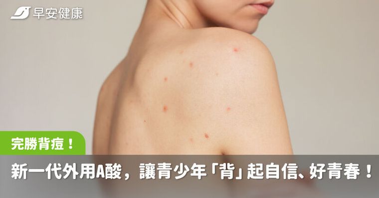 完勝背痘！新一代外用A酸，讓青少年「背」起自信、好青春！