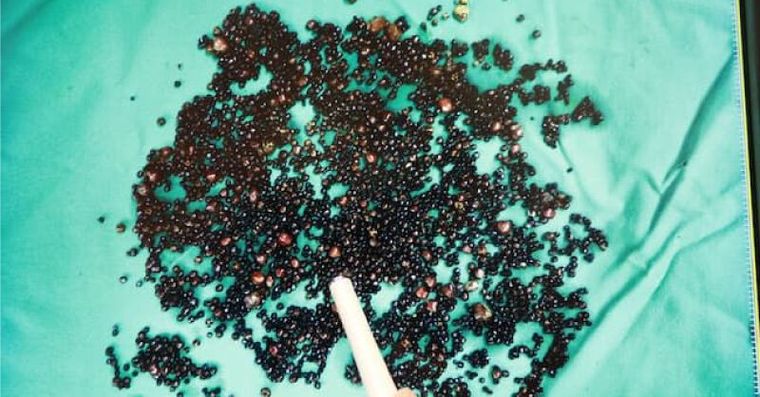 愛吃2種食物，他43歲長5千顆膽結石！上腹痛小心4種器官病變警訊