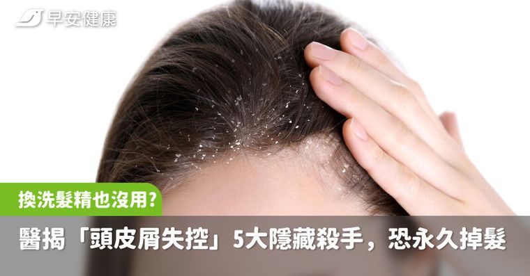 換洗髮精也沒用？醫揭「頭皮屑失控」5大隱藏殺手，放著不管恐永久掉髮