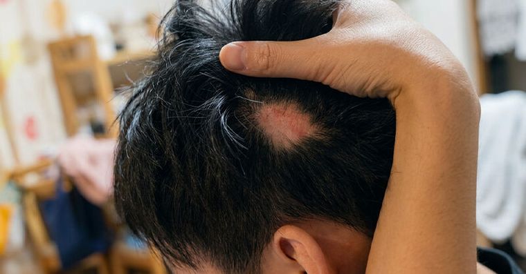 男星自曝「鬼剃頭」全因這行為！救救掉髮補對4營養讓毛囊不罷工