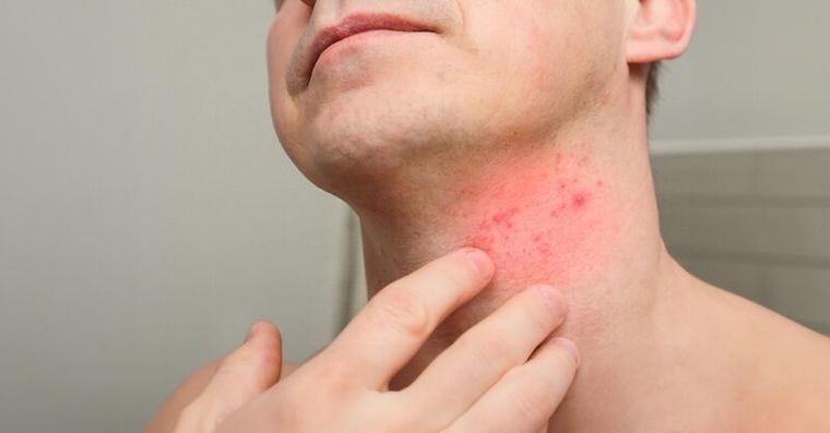 皮蛇初期症狀5警訊，糖尿病患者不可忽略！掌握帶狀疱疹預防關鍵