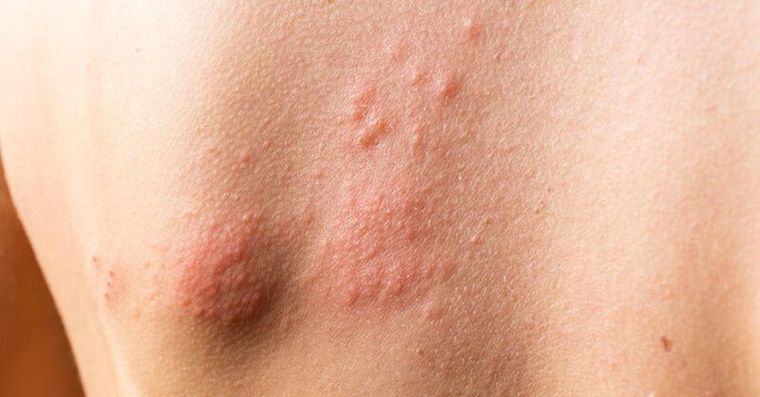 常冒唇皰疹、長皮蛇？皰疹病毒恐傷腦「這樣做」失智風險降23％