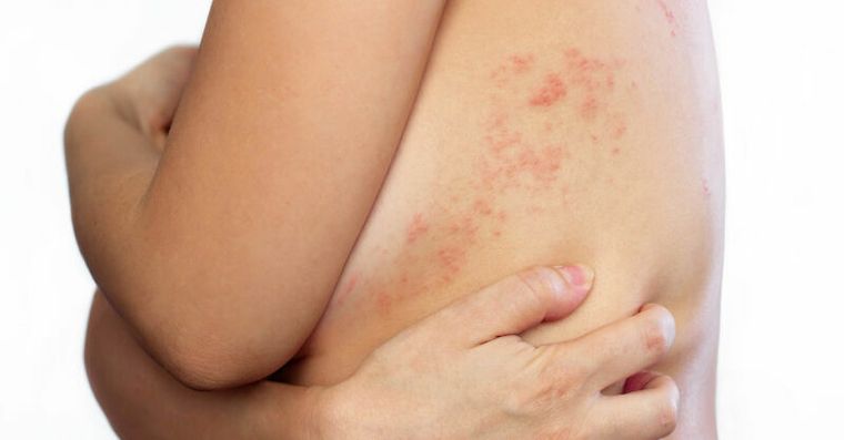 他帶狀皰疹痊癒卻連刷牙、吃飯都會痛！中醫「搜風藥」強效止痛