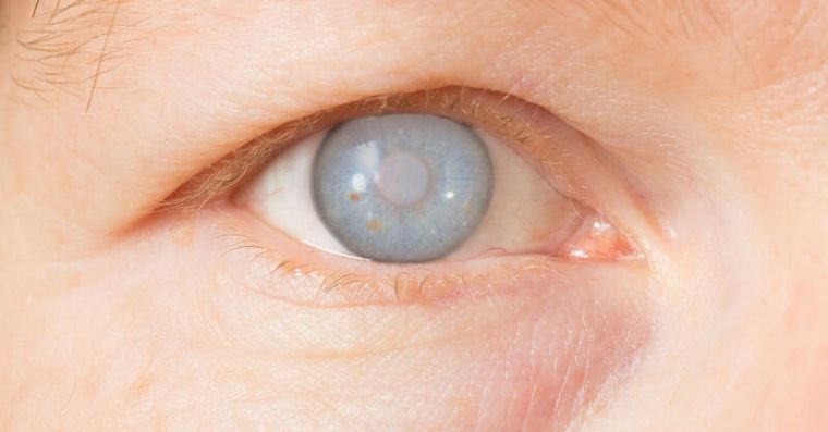 白內障位置決定失明風險！醫揭3大警訊，這混濁位置最危險