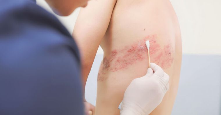水痘、帶狀疱疹會傳染給別人嗎？醫師說明症狀、治療與預防2+4原則大公開