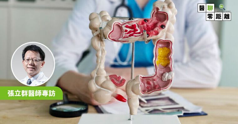 照大腸鏡別白忙！台大醫列3種人「追蹤時間表」這類息肉超快變癌