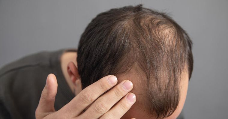 想遮禿卻害毛囊死亡！醫揭「4大致禿陷阱」加速掉髮很難救