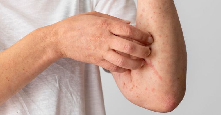 沒碰過敏原卻紅癢、蕁麻疹？醫曝是免疫太緊張「自體過敏」5招舒緩