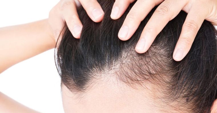 頭髮、髮線長回來了！35歲男實測「一治療」1個月告別掉髮
