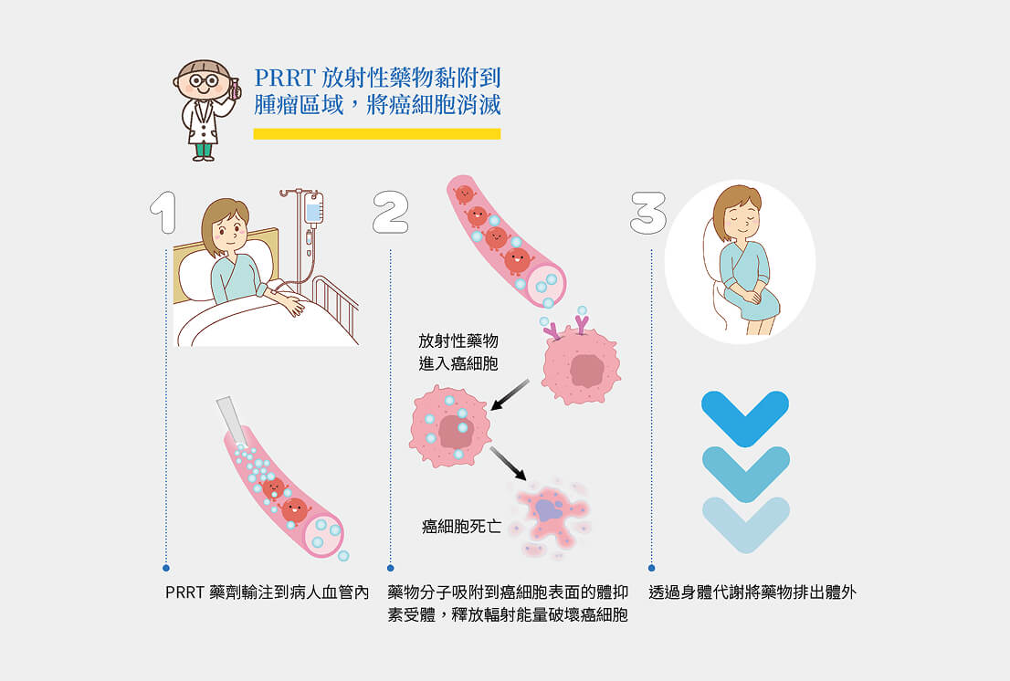 PRRT放射性藥物黏附到腫瘤區域將細胞消滅